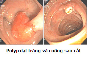 Polyp đại trực tràng và cuống sau cắt hiệu quả