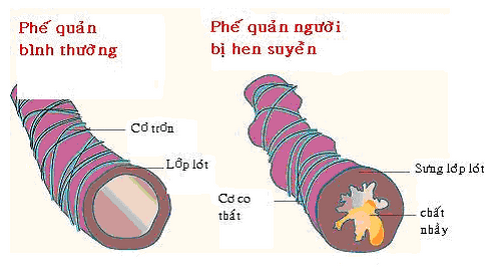 Hen suyễn là tình trạng viêm mạn tính đường thở, hậu quả của quá trình tương tác giữa cơ địa dị ứng với các yếu tố gây bệnh hen suyễn từ ngoài môi trường.