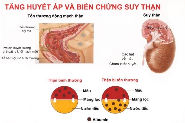 Tăng huyết áp - nguyên nhân gây suy thận