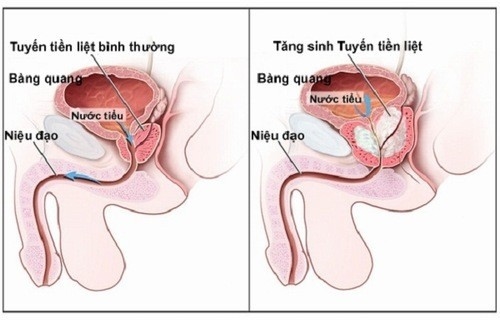 Vôi hóa tuyến tiền liệt có thể do nhiều nguyên nhân gây ra cần được phát hiện sớm và điều trị đúng cách