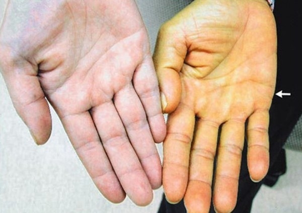 Người mắc bệnh gan thường có da vàng hơn bình thường