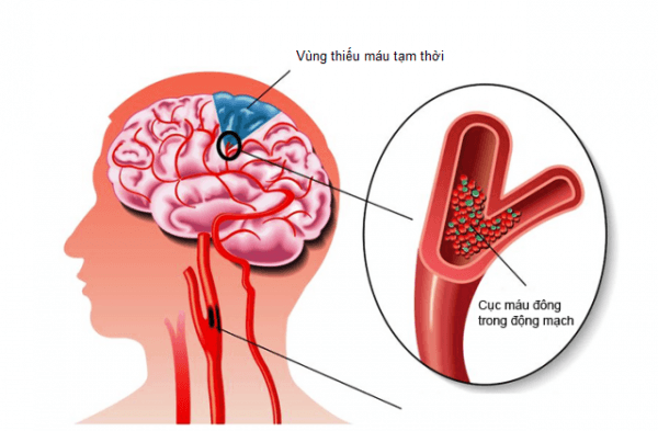 Mảng xơ vữa là nguyên nhân gây thiếu máu lên não