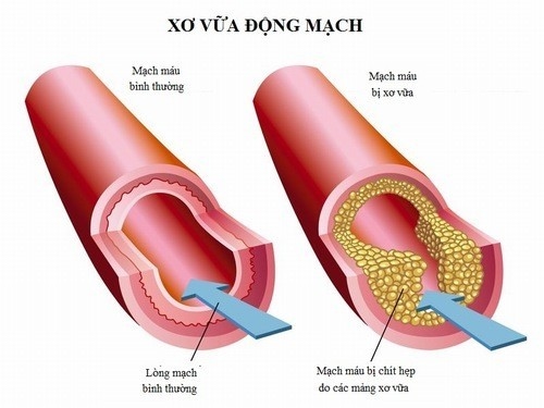 Xơ vữa động mạch là nguyên nhân gây bệnh đột quỵ