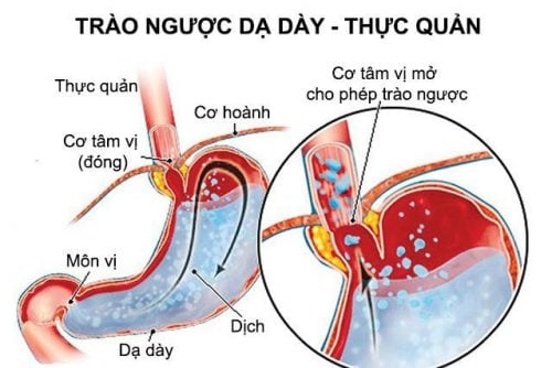 Điều trị viêm thực quản trào ngược