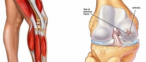 Thoái hóa khớp có thể là nguyên nhân gây khô khớp