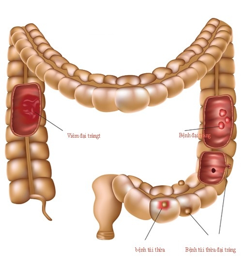 Bệnh đường viêm ruột được chia làm 2 loại: bệnh viêm ruột kết gây loét và bệnh Crohn.