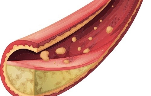 Cholesterol dư thừa có thể xâm nhập vào màng của thành mạch máu, góp phần làm xơ cứng động mạch (xơ vữa động mạch) và bệnh tim.