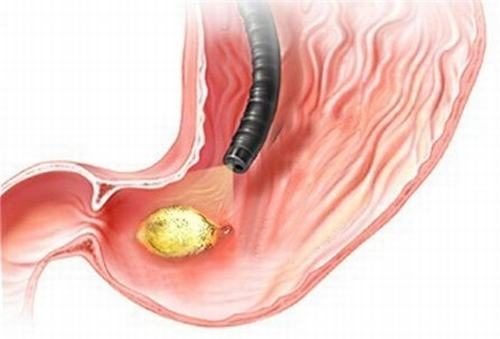 Nhiều bạn đọc muốn tìm hiểu: Bệnh dạ dày lây qua đường nào?