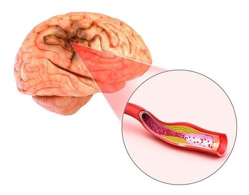 Người có nồng độ cholesterol trong máu cao có nguy cơ bị đột quỵ