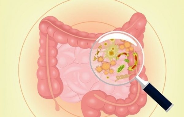 Viêm đường ruột được chia làm 2 loại đó là bệnh viêm ruột kết gây loét và bệnh Crohn