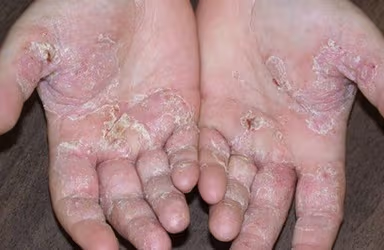 Bệnh á sừng có chữa khỏi được không?