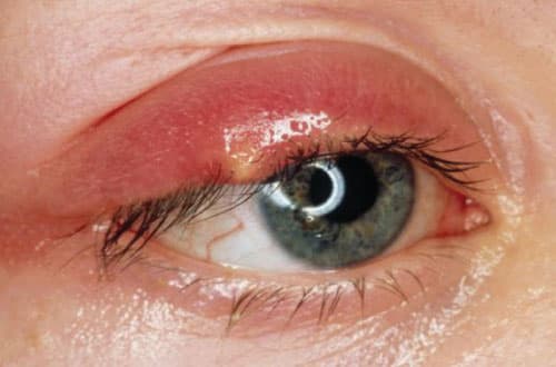 Chứng lẹo mắt xảy ra khá phổ biến và thường được chữa trị bằng thủ thuật trích lẹo.