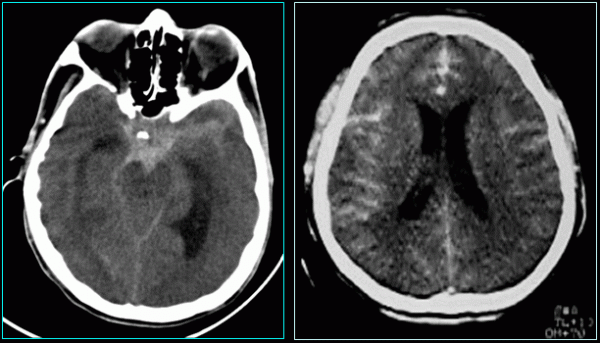 Bác sĩ có thể đề nghị người bệnh thực hiện các xét nghiệm hình ảnh, chẳng hạn như chụp CT để phát hiện xuất huyết nội hoặc máu tụ.