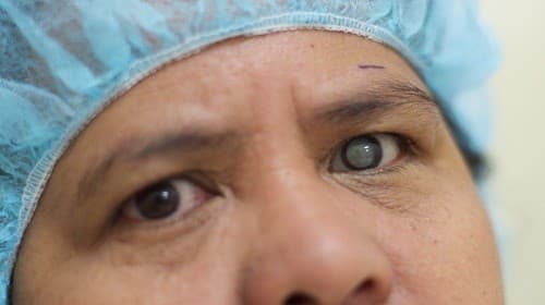 Những tác hại của bệnh đục thủy tinh thể với mắt là rất lớn, đặc biệt nếu không chữa trị kịp thời, bệnh có thể gây mù lòa.