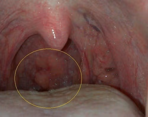 Những tổn thương ác tính ở amidan nếu được phát hiện muộn, điều trị sẽ rất khó khăn