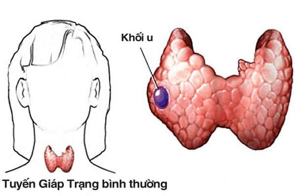 Ung thư tuyến giáp