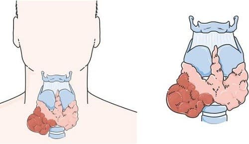 Ung thư tuyến giáp được chia thành nhiều thể khác nhau nhưng hay gặp nhất là hình ảnh ung thư tuyến giáp dạng nhú