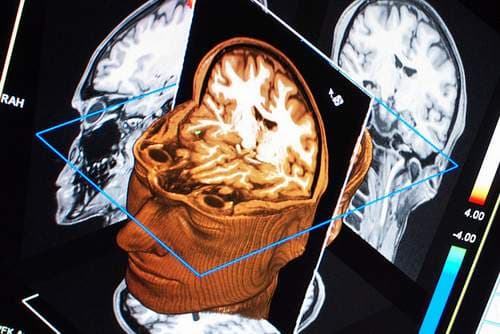 Chấn thương sọ não thường bắt nguồn từ các loại chấn thương bao gồm chảy máu, chấn động mạnh (rung động não hoặc não bị bầm).