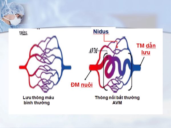 Bệnh dị dạng động tĩnh mạch (AVM) hay gặp ở hệ thống thần kinh trung ương nhưng cũng có thể gặp ở mọi ví trí trong cơ thể.