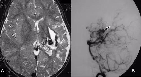 Việc chẩn đoán bệnh dị dạng động tĩnh mạch dựa vào các triệu chứng lâm sàng và các kĩ thuật thăm dò hình ảnh
