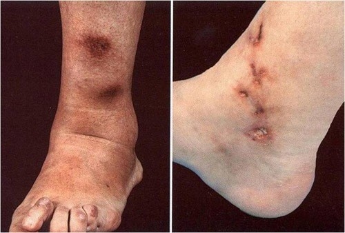 Viêm nút quanh động mạch là bệnh viêm mạch hệ thống ở nhiều cơ quan trong cơ thể