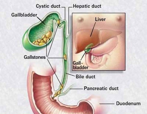 Tắc nghẽn ống dẫn mật chủ yếu do sỏi mật gây ra