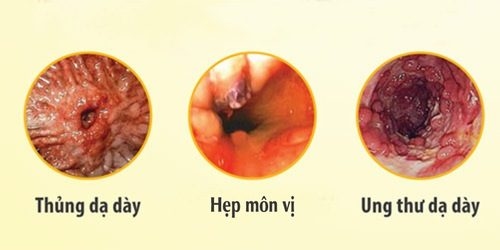 Viêm dạ dày cấp tính nếu không được điều trị sớm có thể gây nhiều biến chứng nguy hiểm