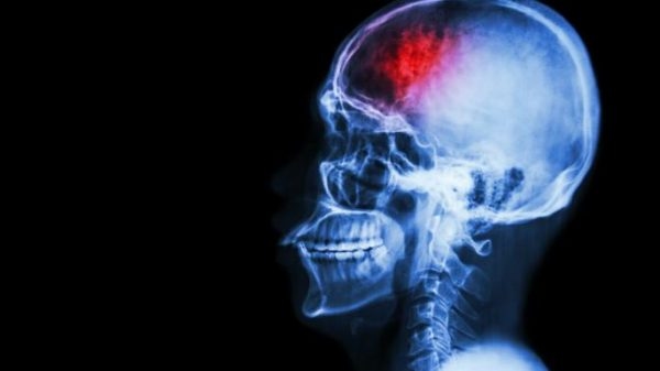 cach-cham-soc-benh-nhan-chan-thuong-so-nao-2