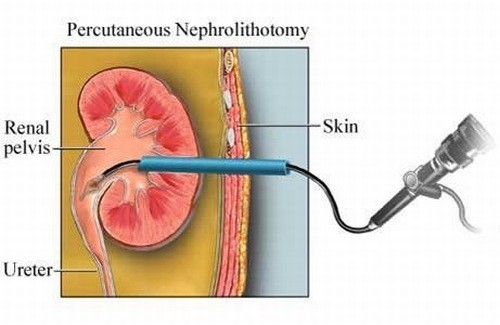 Mổ nội soi lấy sỏi niệu quản cần được thực hiện tại bệnh viện uy tín