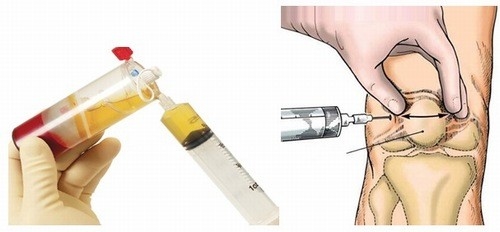 Có nên tiêm chất nhờn vào khớp khi bị thoái hóa?