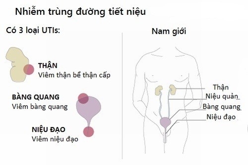 Viêm đường tiết niệu ở nam giới cần được phát hiện sớm và điều trị kịp thời hiệu quả