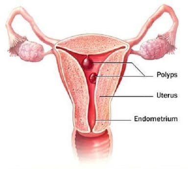 Bệnh polyp cổ tử cung là gì và những điều cần biết