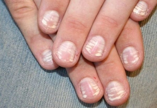 nấm mốc móng tay