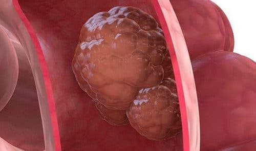 Bác sĩ sẽ xác định được kích thước, vị trí khối u khi nhìn vào hình ảnh nội soi ung thư đại tràng