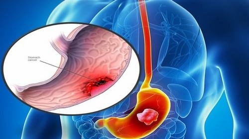 Nội soi dạ dày kết hợp với làm sinh thiết sẽ giúp phát hiện sớm ung thư dạ dày