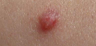 Mụn cóc sinh dục và những điều cần biết