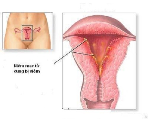 Viêm nội mạc tử cung là bệnh lý phụ khoa mà không ít chị em mắc phải