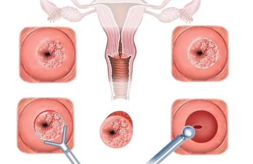 Vì vậy, nếu bạn đã có kết quả xét nghiệm Pap smear bất thường, bạn càng cầm làm các xét nghiệm khác theo các khuyến nghị của bác sĩ