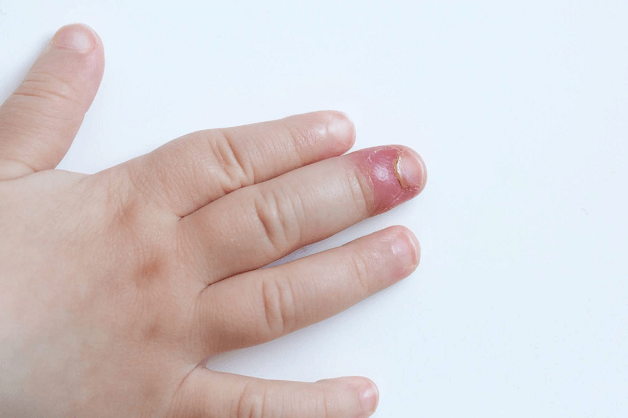 điều trị bệnh chín mé