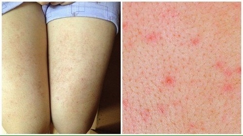 Viêm lỗ chân lông là bệnh khá phổ biến
