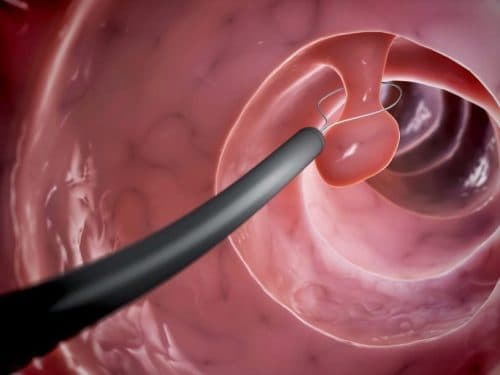 Phẫu thuật cắt polyp bằng phương pháp nội soi an toàn, hiệu quả