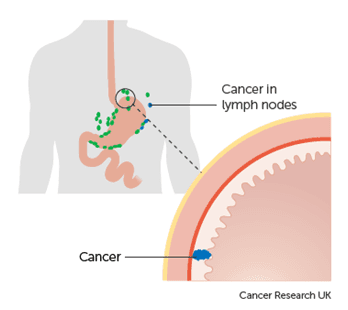 Ung thư dạ dày giai đoạn đầu có chữa được không