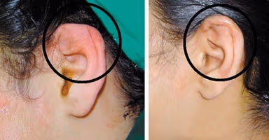 Viêm sụn vành tai phải làm sao?