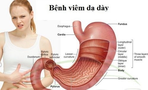 Bệnh viêm dạ dày có khó chữa không là thắc mắc chung của nhiều người