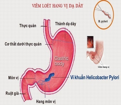viêm xung huyết hang vị dạ dày cần được chẩn đoán phát hiện sớm và điều trị kịp thời hiệu quả