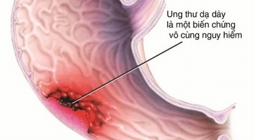 Ung thư dạ dày là biến chứng nguy hiểm