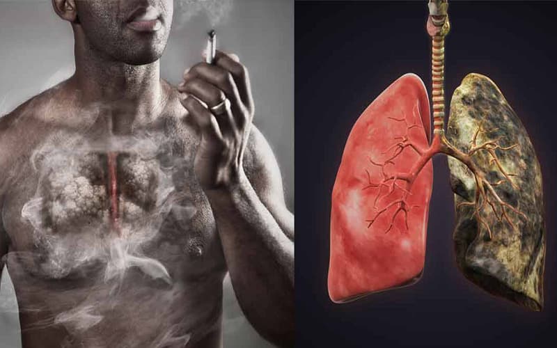 Bệnh nhân ung thư phổi giai đoạn cuối thường có hạch lớn, gắn chặt, không di động ở vùng cổ