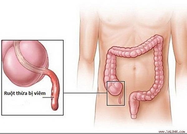 mổ ruột thừa và những điều cần biết về ruột thừa