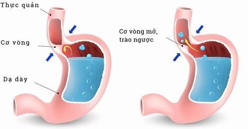 Trào ngược dạ dày thực quản là bệnh phổ biến thường gặp ở đường tiêu hóa