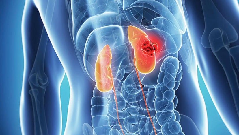 Ung thư thận giai đoạn 1 sống được bao lâu?